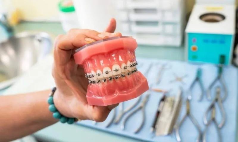 Zdjęcie Ile kosztuje aparat na zęby góra i dół? Poznaj ukryte wydatki