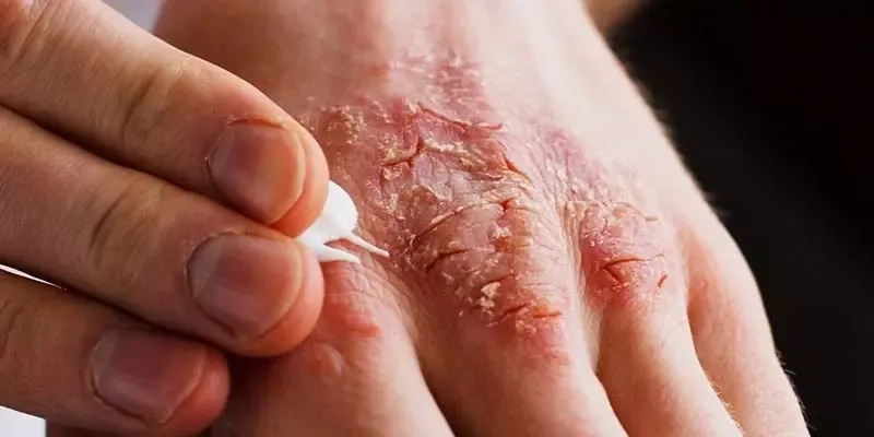 Zdjęcie Skutki uboczne Avastinu: prawdziwe doświadczenia pacjentów na forum