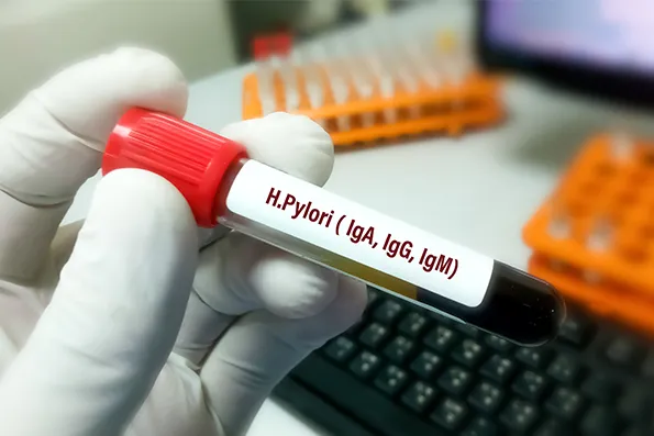 Zdjęcie NFZ nie refunduje badania helicobacter pylori z krwi – co wybrać?