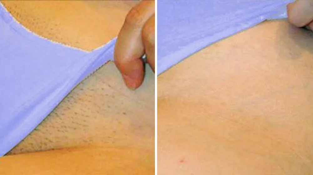 Zdjęcie Ile zabiegów depilacji laserowej bikini potrzebujesz dla trwałych efektów?