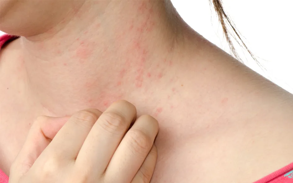 Zdjęcie Allergie Symptome: So erkennen Sie gefährliche Reaktionen rechtzeitig