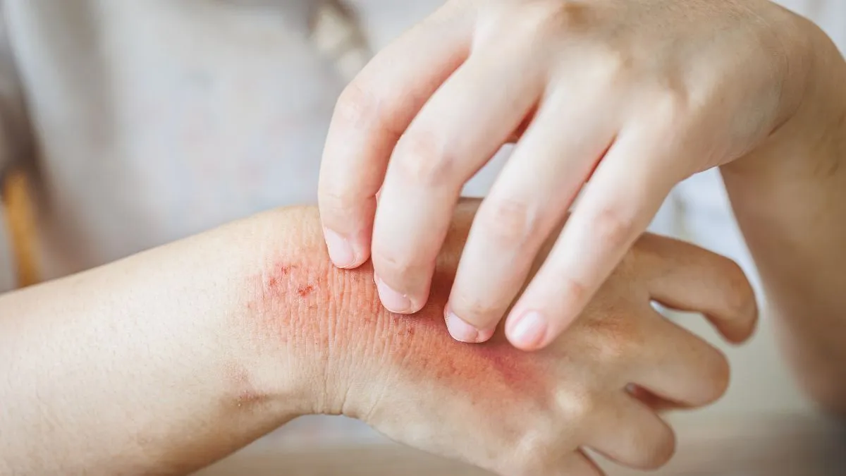 Zdjęcie Co na liszaj u dziecka? Skuteczne metody leczenia i pielęgnacji