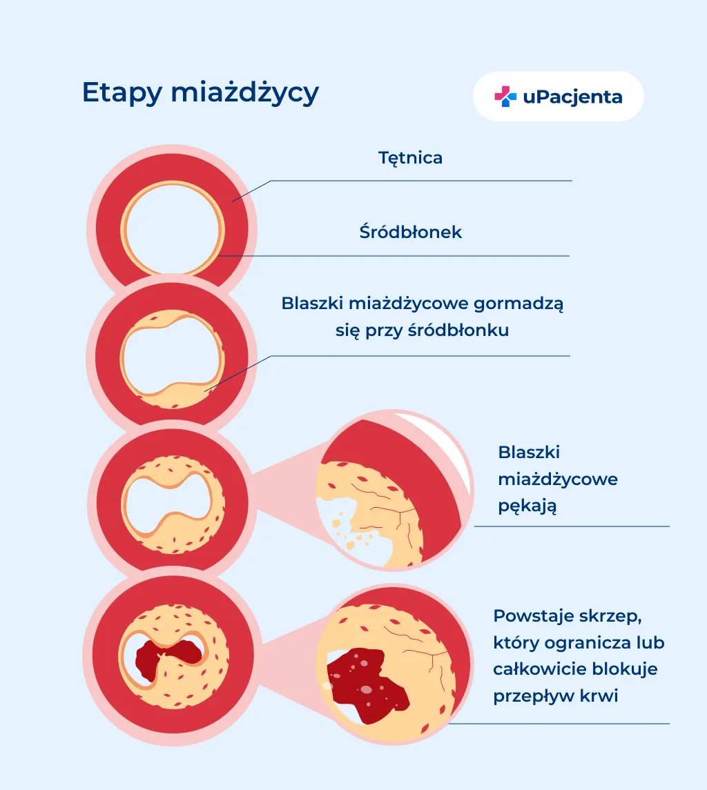Zdjęcie Miażdżyca objawy psychiczne: jak rozpoznać i zminimalizować skutki