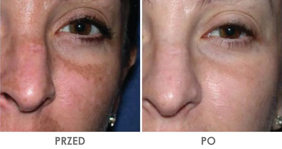 Zdjęcie Gdzie kupić deep phyto peeling? Sprawdź najlepsze opcje i ceny