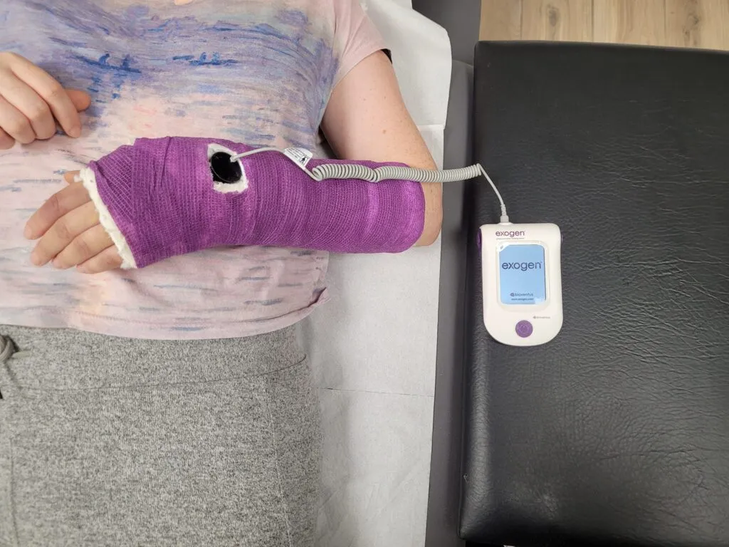 Zdjęcie Złamanie łokcia ile gips – ile czasu musisz nosić gips?