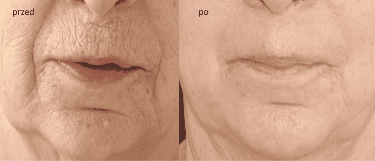 Zdjęcie Peeling fenolowy ile się goi - poznaj czas regeneracji skóry