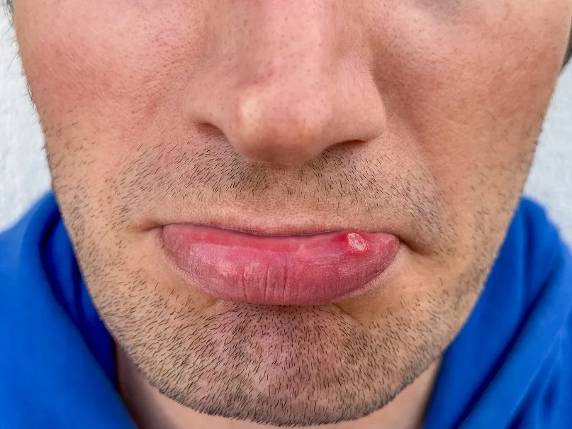 Zdjęcie Ile goi się rana w jamie ustnej i co wpływa na czas gojenia