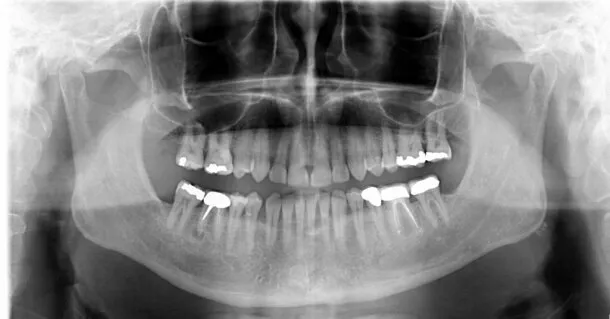 Zdjęcie Ząb 36 który to: kluczowe informacje o jego roli i lokalizacji