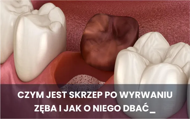 Zdjęcie Ile goi się dziąsło po wyrwaniu zęba? Czas i czynniki wpływające na proces