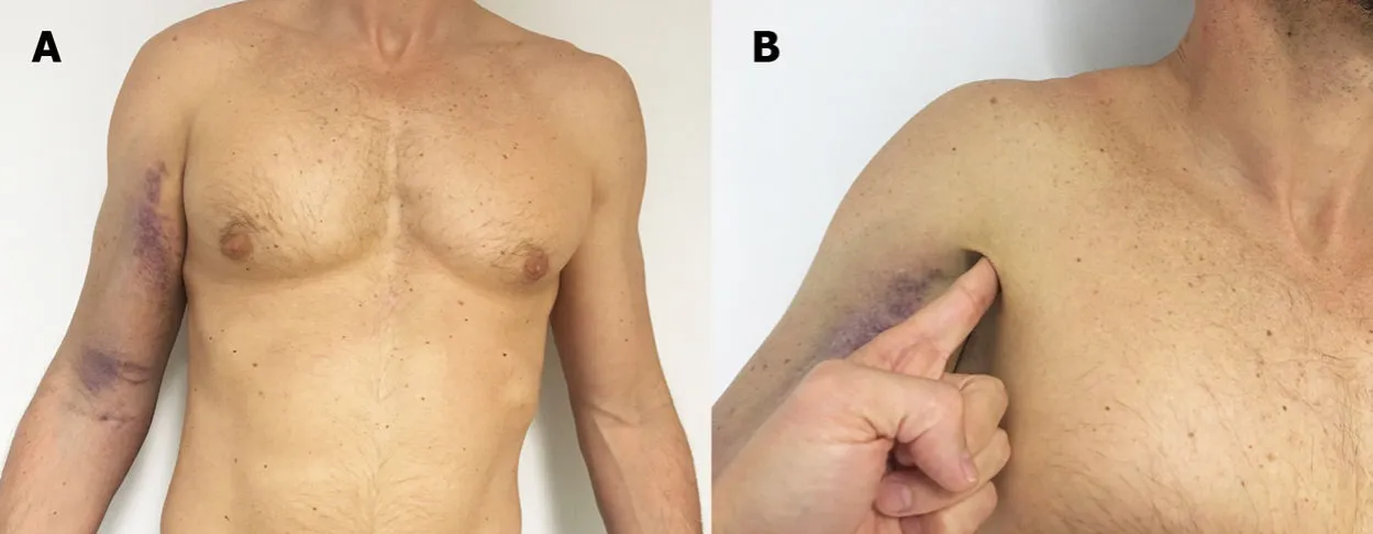 Zdjęcie Desgarro muscular en el pecho: síntomas, causas y tratamientos efectivos