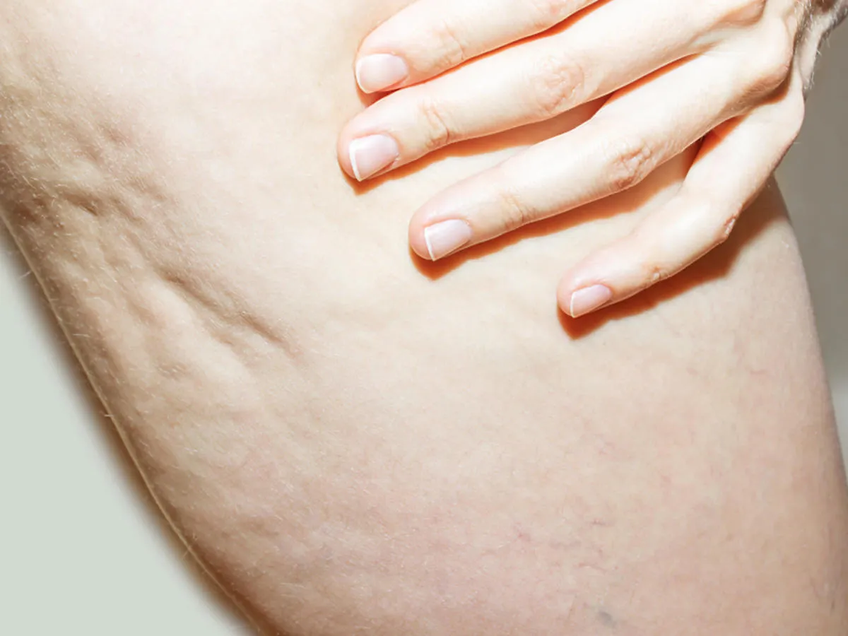 Zdjęcie Jak wygląda cellulit wodny? Objawy, cechy i różnice z tłuszczowym