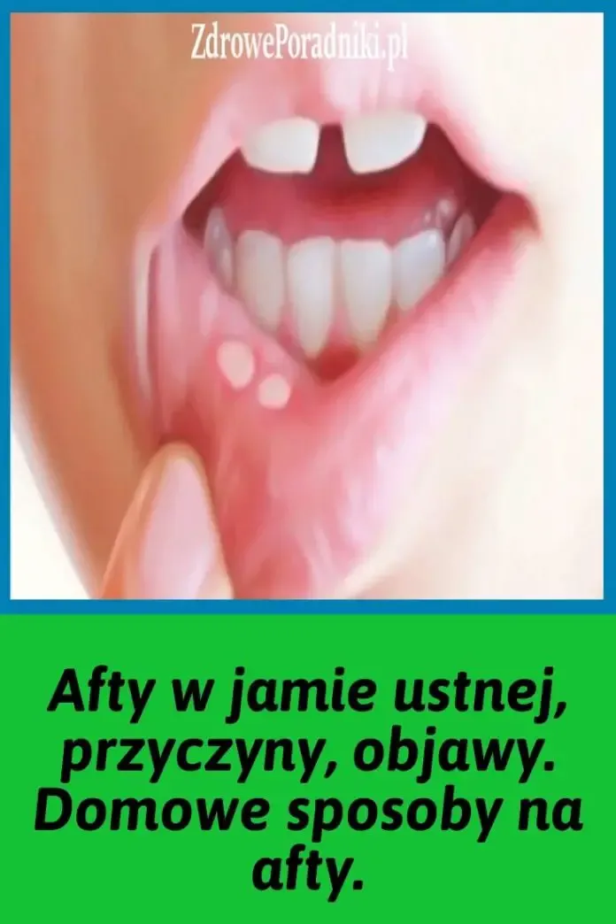 Zdjęcie Co to jest afta w jamie ustnej? Przyczyny, objawy i skuteczne sposoby leczenia