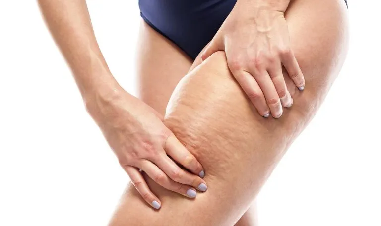 Zdjęcie Dlaczego mężczyźni nie mają cellulitu? Oto zaskakujące przyczyny