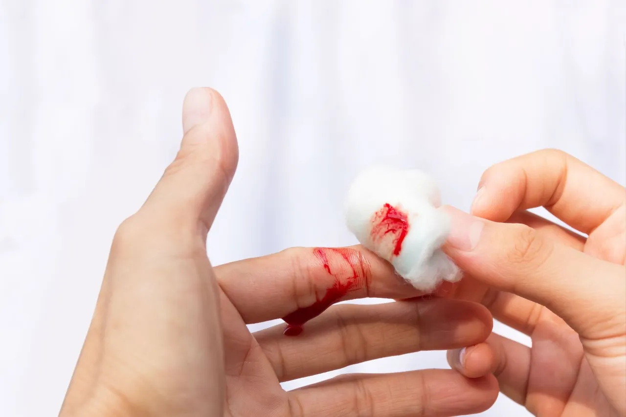 Zdjęcie Zaburzenia hemostazy objawy – jak je rozpoznać i unikać powikłań