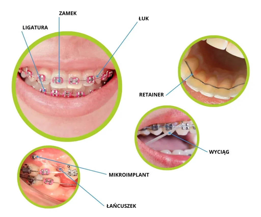 Zdjęcie Jak działa aparat na zęby? Poznaj proces i efekty leczenia