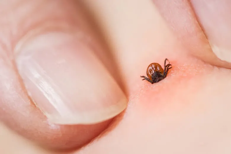 Zdjęcie Kleszcz u dziecka: kiedy antybiotyk jest naprawdę konieczny?