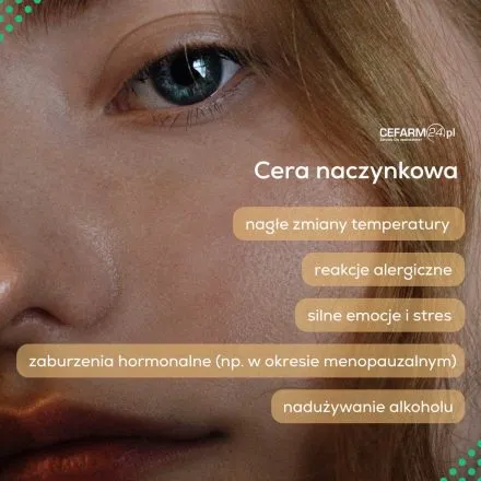 Zdjęcie Jak pozbyć się cery naczynkowej: 9 skutecznych metod leczenia
