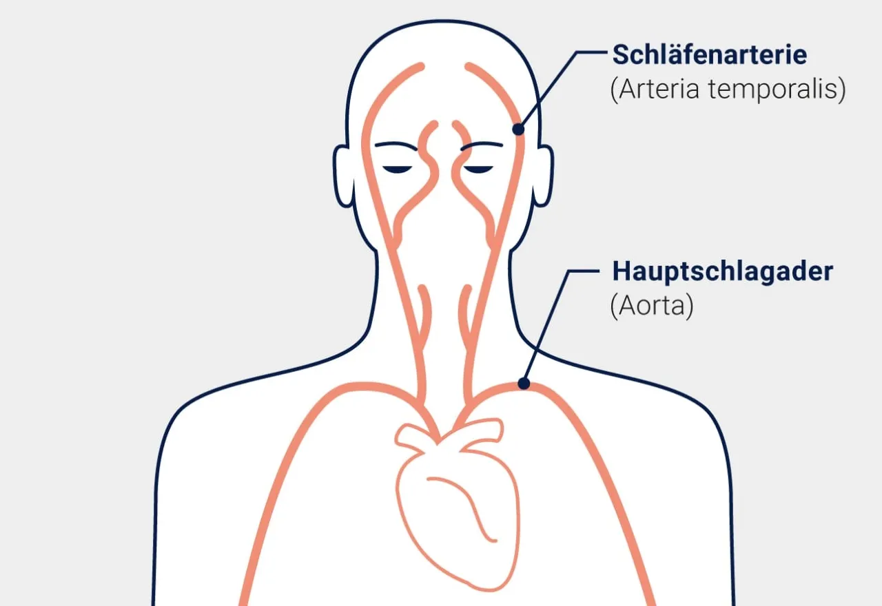Zdjęcie Morbus Horton Diagnostik: Wichtige Kriterien und Symptome erkennen