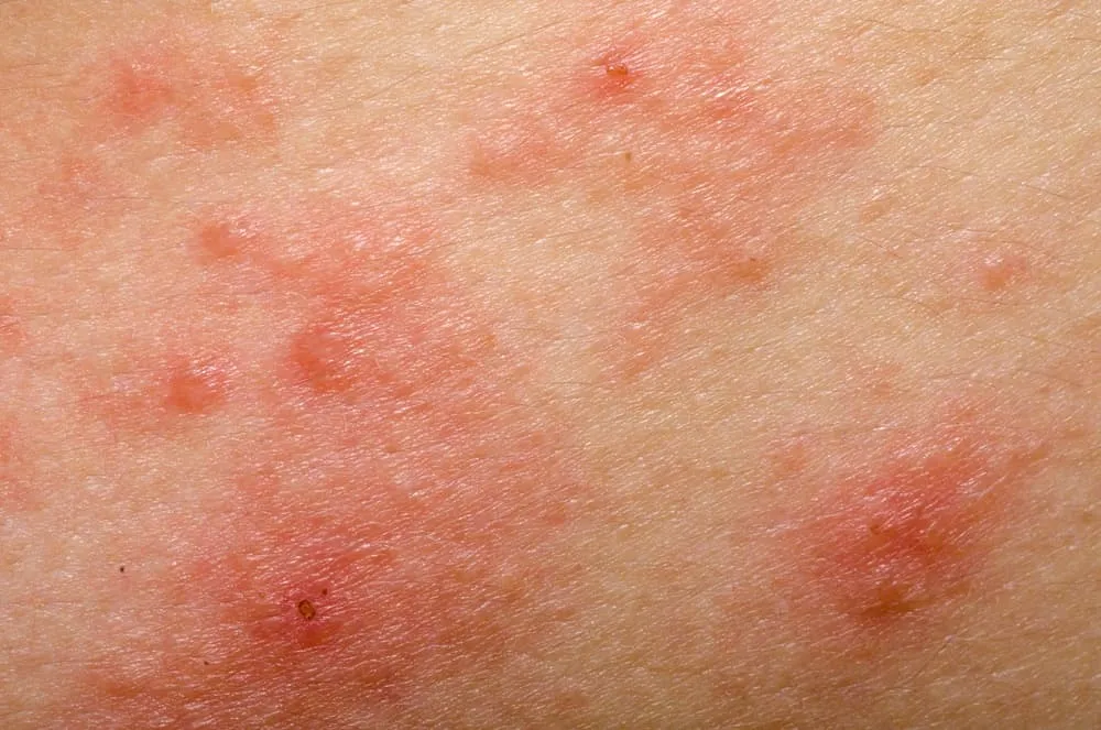 Zdjęcie Alergia na sierść objawy skórne – jak je rozpoznać i leczyć
