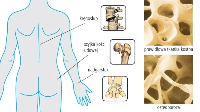 Zdjęcie Objawy osteoporozy: jak je rozpoznać i kiedy udać się do lekarza