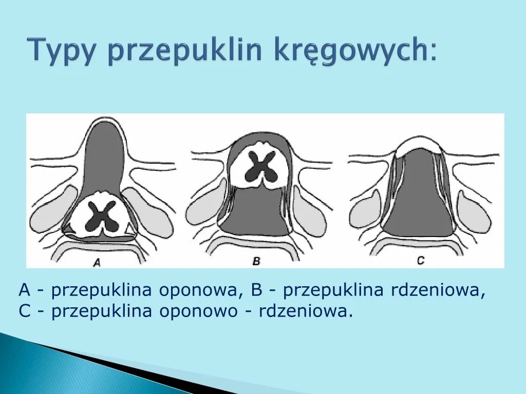 Zdjęcie Przepuklina jaki lekarz - kogo wybrać, aby uniknąć problemów zdrowotnych