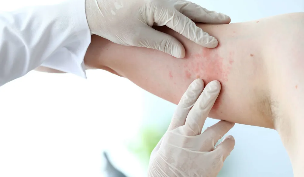 Zdjęcie Uczulenie na buty objawy: jak rozpoznać i unikać alergii skórnych