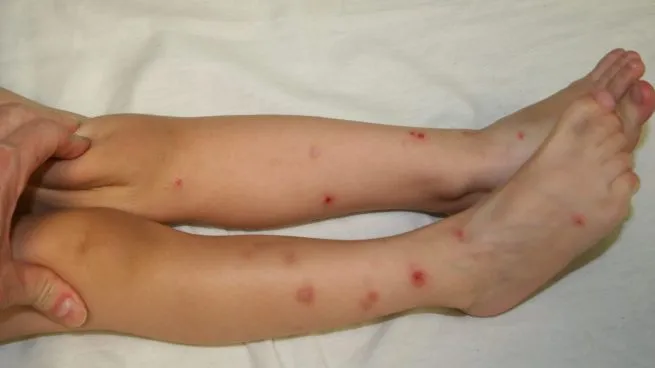 Zdjęcie Diferencias entre ácaros y pulgas: síntomas y tratamiento de picaduras