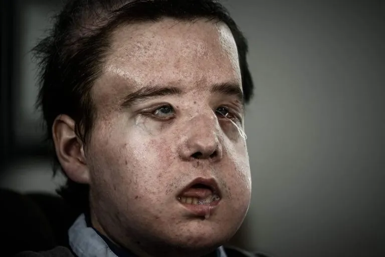 Zdjęcie Pierwszy na świecie przeszczep twarzy - historia, która zmienia życie