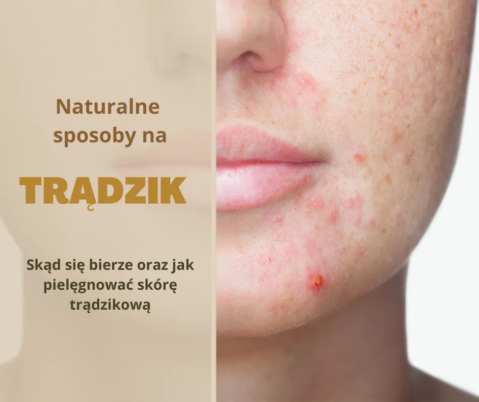 Zdjęcie Cera trądzikowa co stosować, aby skutecznie zwalczyć trądzik