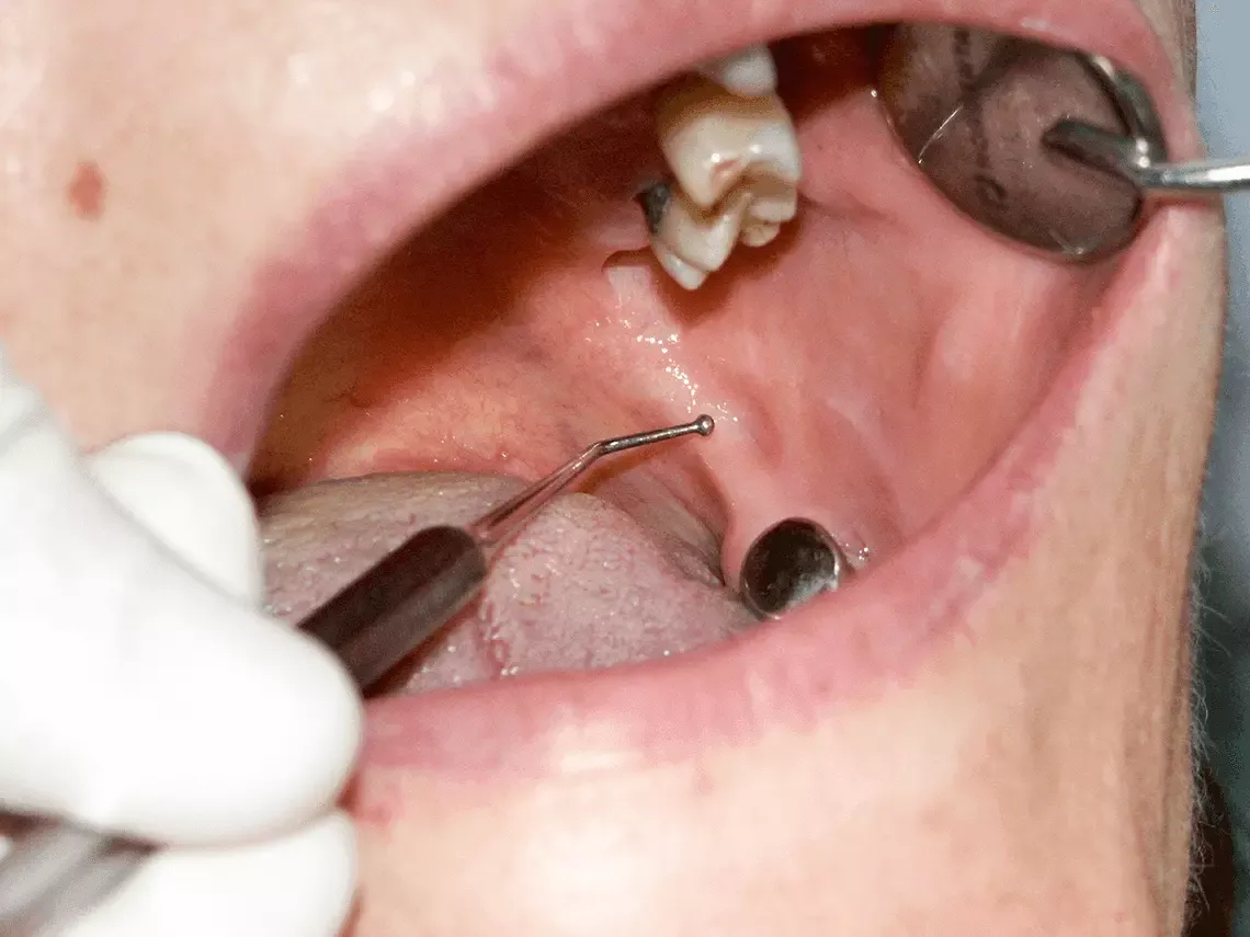 Zdjęcie Jak długo trzyma znieczulenie od dentysty? Czas trwania i objawy