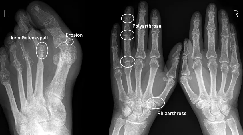 Zdjęcie Die entscheidende Rolle der Diagnostik bei rheumatischer Arthritis