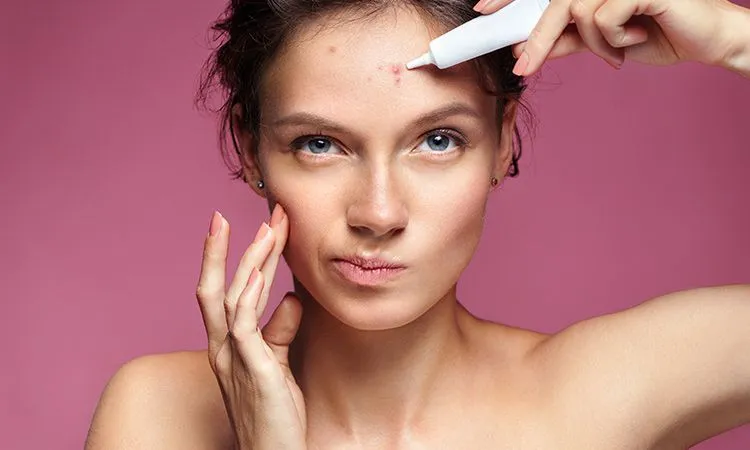 Zdjęcie Jak szybko pozbyć się pryszcza? Sprawdzone metody i triki!