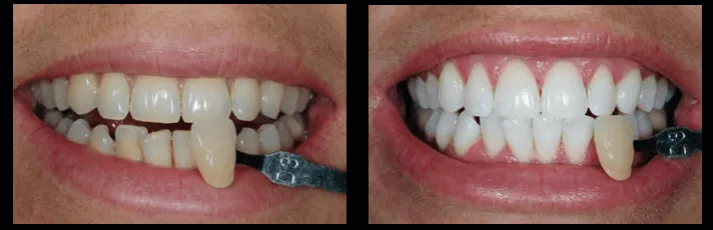 Zdjęcie Wybielanie zębów u dentysty: Koszt, efekty i bezpieczeństwo. Poznaj fakty.