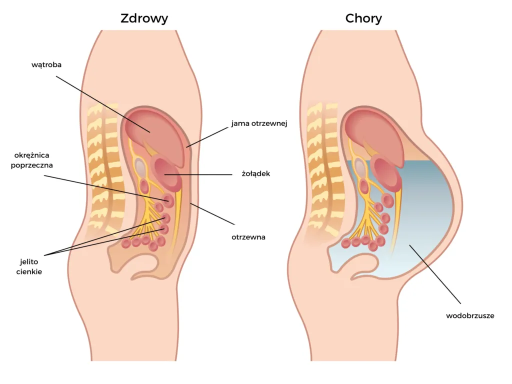 Zdjęcie Pierwsze objawy marskości wątroby - na co zwrócić uwagę już dziś