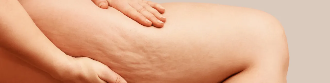 Zdjęcie Jak skutecznie pozbyć się cellulitu z brzucha i odzyskać gładką skórę