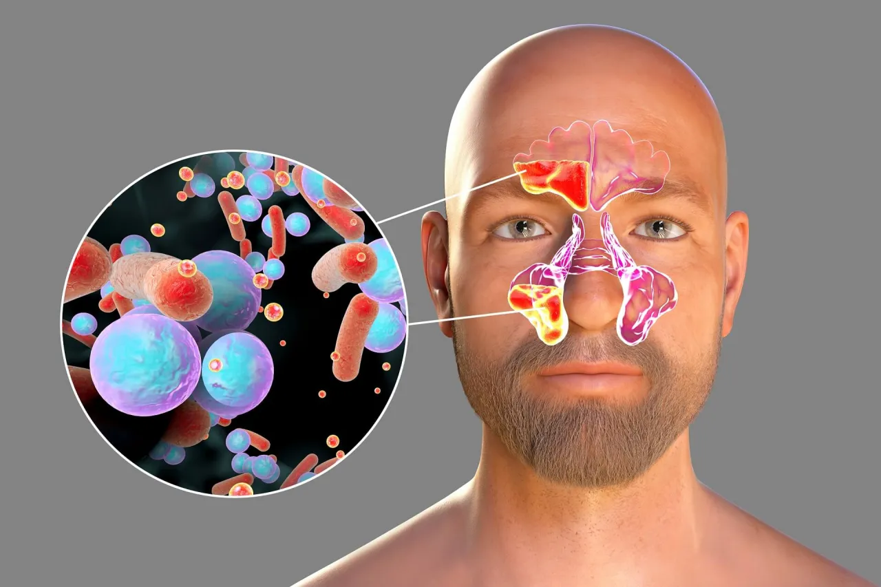 Zdjęcie Medycyna chińska zatoki: Jak skutecznie leczyć zapalenie zatok?