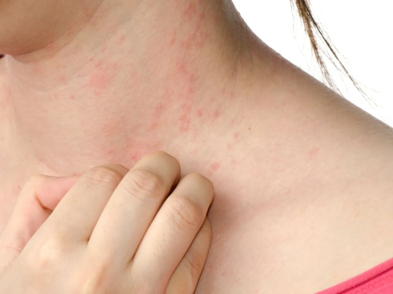 Zdjęcie Czy alergia może pojawić się później? Zaskakujące fakty o alergiach