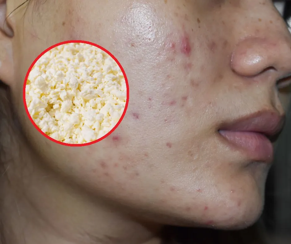 Zdjęcie Czego nie jeść aby mieć ładną cerę? Unikaj tych produktów dla zdrowej skóry