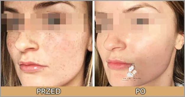 Zdjęcie Jaki peeling przed goleniem? Najlepsze rodzaje dla Twojej skóry