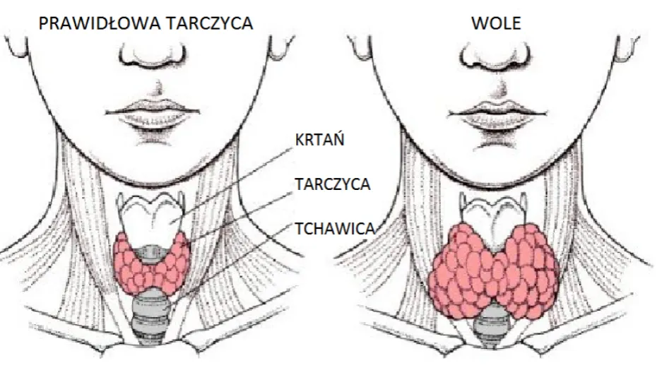 Zdjęcie Niedoczynność tarczycy przyczyny: co może prowadzić do problemów?