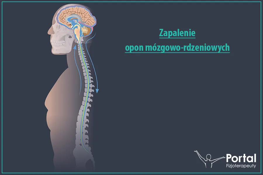Zdjęcie Zapalenie opon mózgowych: najczęstsze objawy, które musisz znać