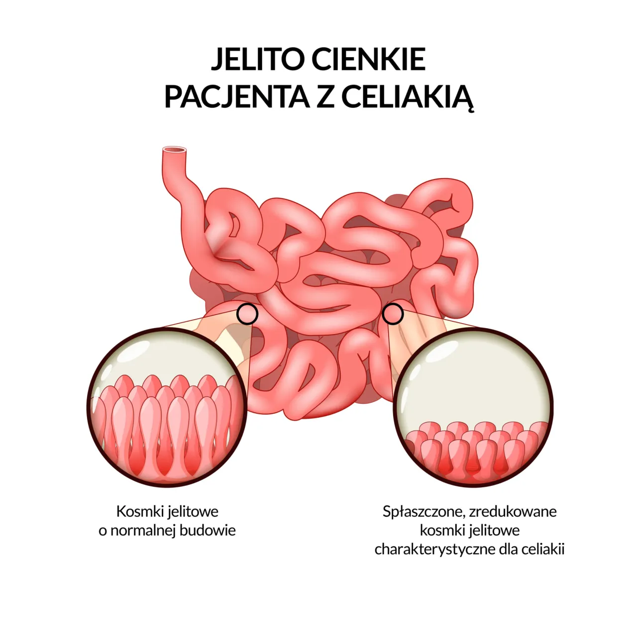 Zdjęcie Celiakia jaki lekarz - kluczowe informacje, które mogą uratować zdrowie