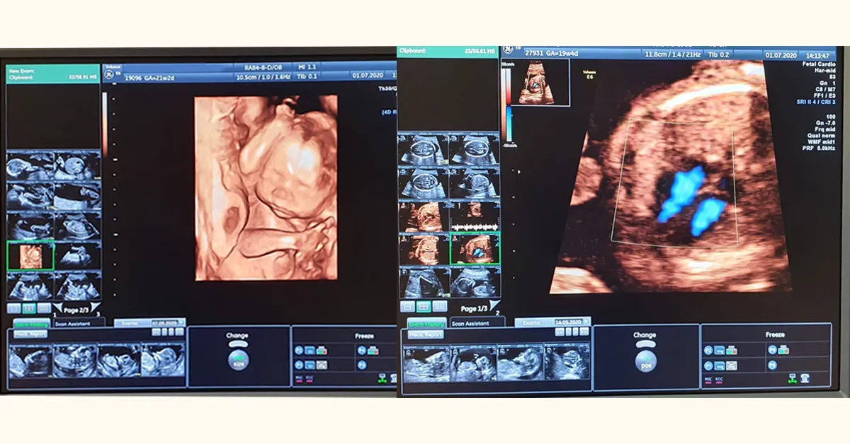 Zdjęcie Drugie badania prenatalne kiedy najlepiej wykonać dla bezpieczeństwa dziecka