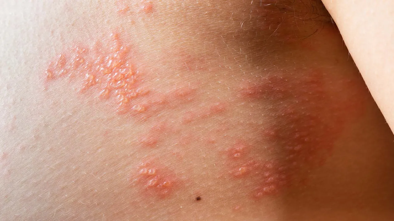 Zdjęcie Die besten Medikamente gegen Gürtelrose: Linderung der Schmerzen und Symptome