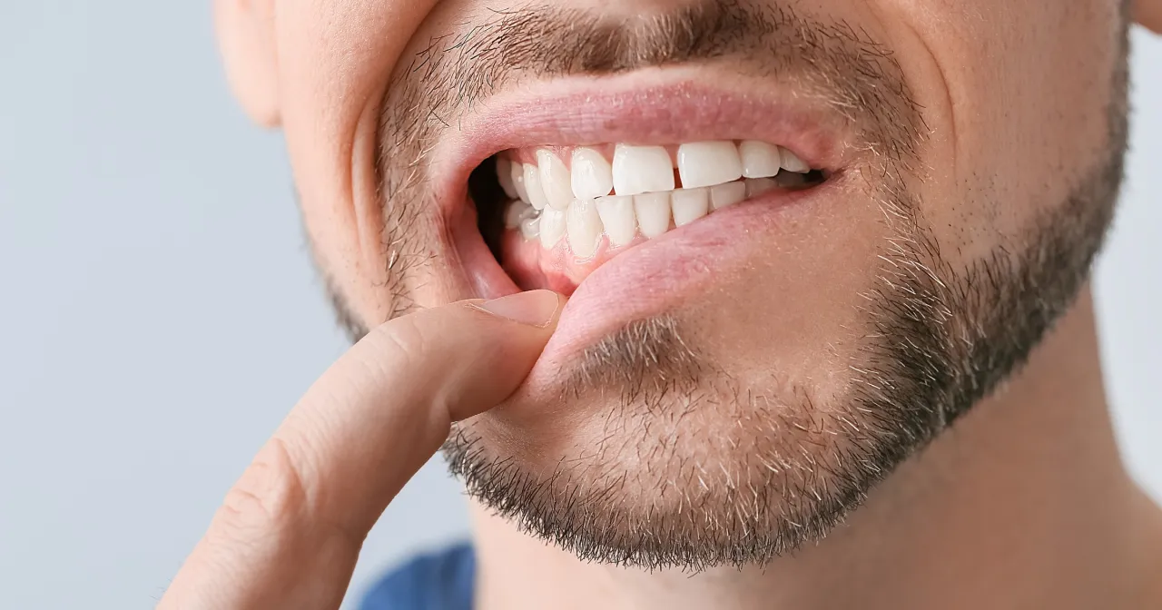 Zdjęcie Ropa w dziąśle: domowe sposoby i kiedy iść do dentysty