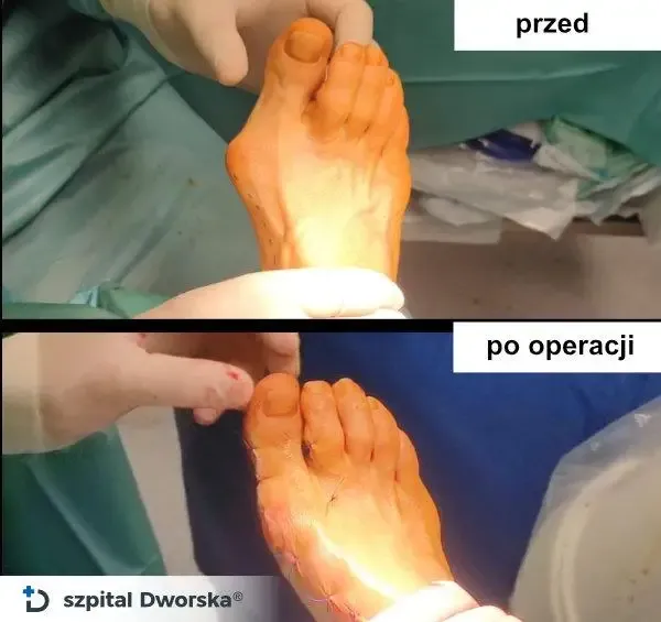 Znieczulenie do operacji haluksa: Wybierz komfort i bezpieczeństwo