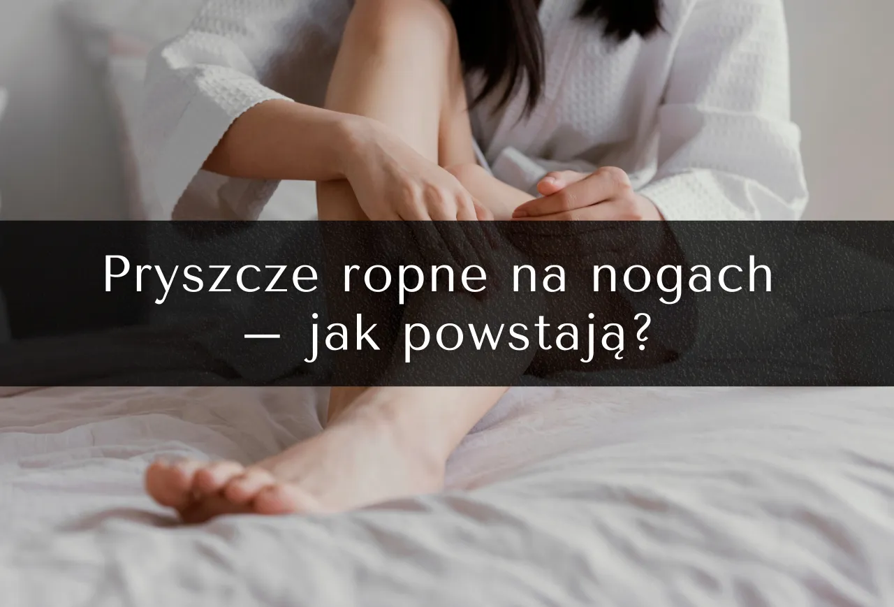 Pryszcze na nogach od czego: Poznaj przyczyny i skuteczne rozwiązania