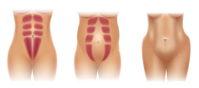 Przepuklina kresy białej - 5 kluczowych objawów, które musisz znać