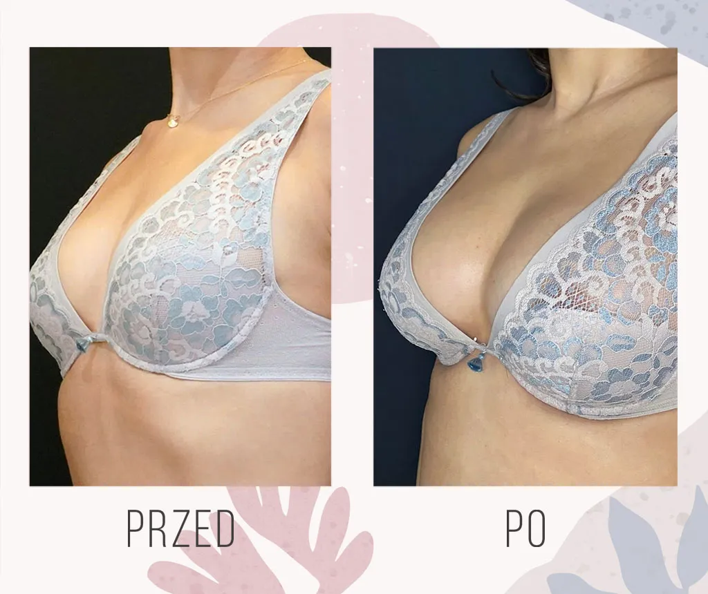 Naturalne powiększanie piersi - skuteczne metody i opinie z forum