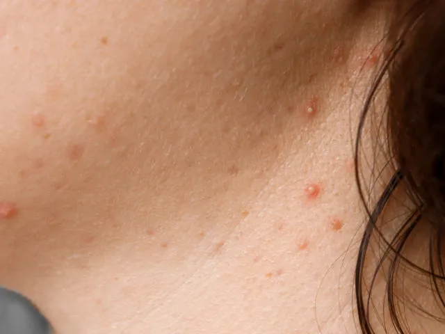 Pryszcze na szyi co oznaczają i jak uniknąć ich powstawania